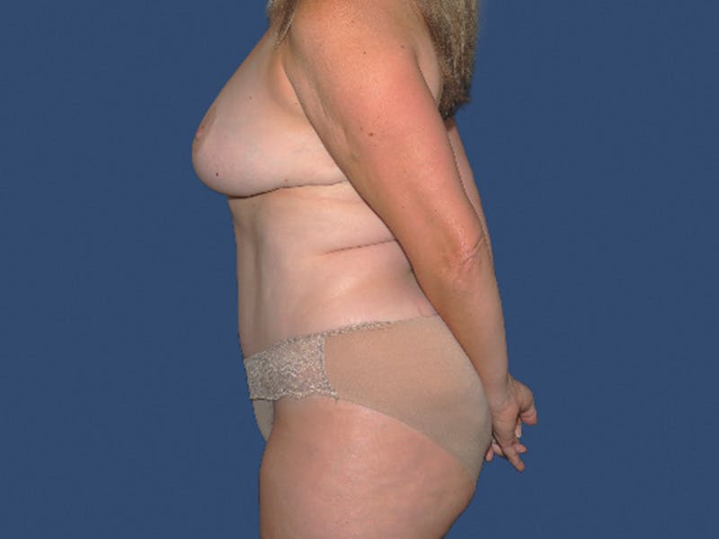 Tummy Tuck Before & After Gallery - Patient 342232 - Image 4