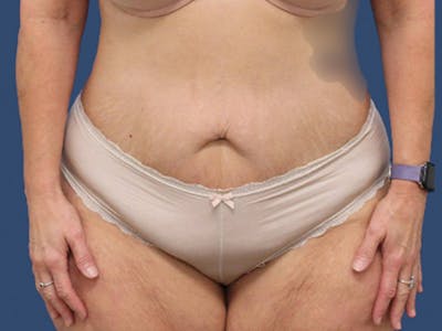 Tummy Tuck Before & After Gallery - Patient 113441 - Image 1
