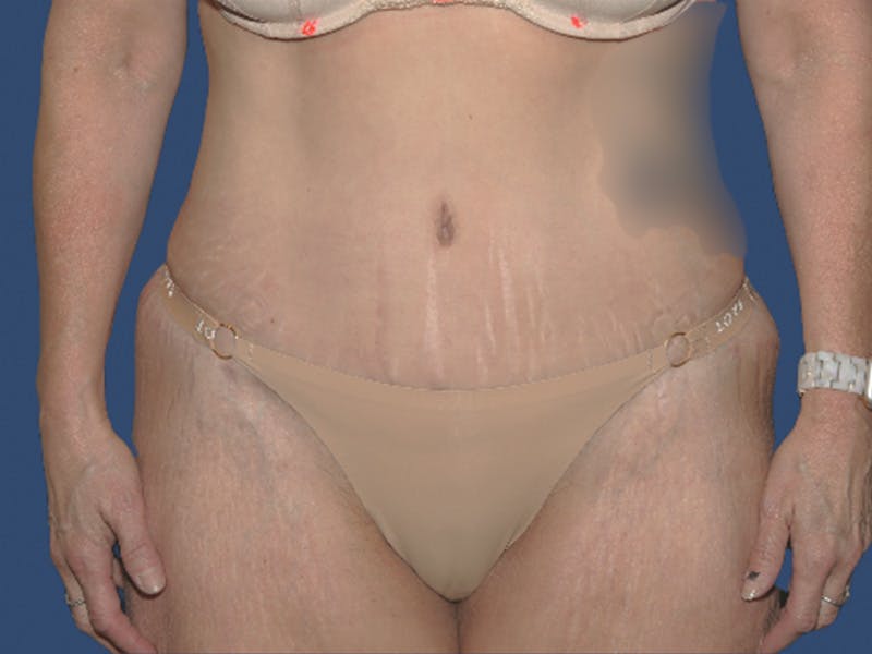 Tummy Tuck Before & After Gallery - Patient 113441 - Image 2