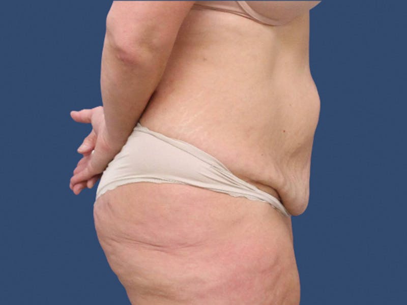 Tummy Tuck Before & After Gallery - Patient 113441 - Image 3