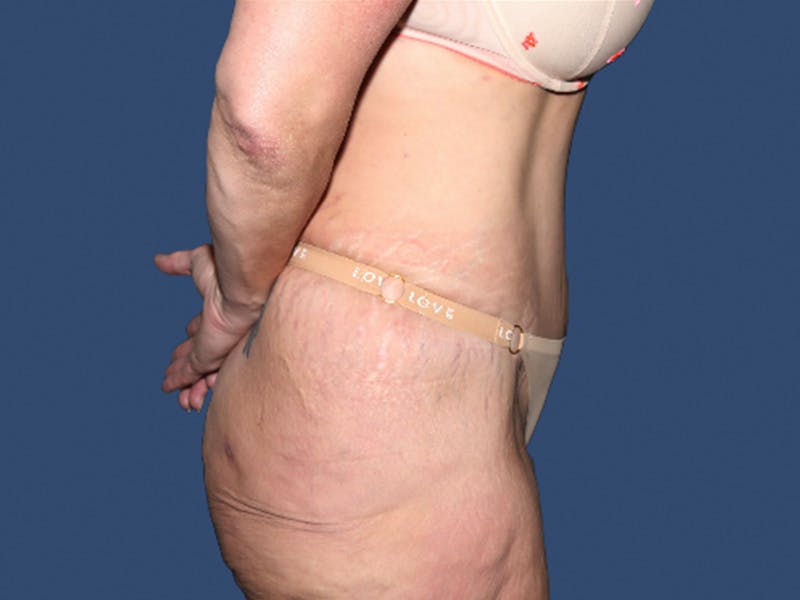 Tummy Tuck Before & After Gallery - Patient 113441 - Image 4