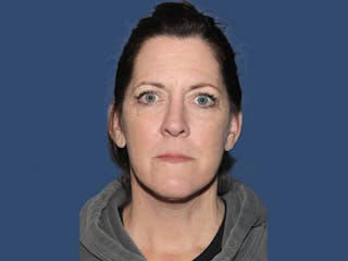 Facelift Before & After Gallery - Patient 309242 - Image 2