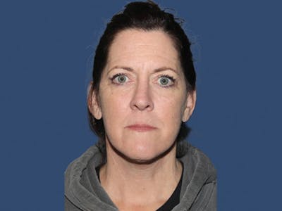 Facelift Before & After Gallery - Patient 309242 - Image 2