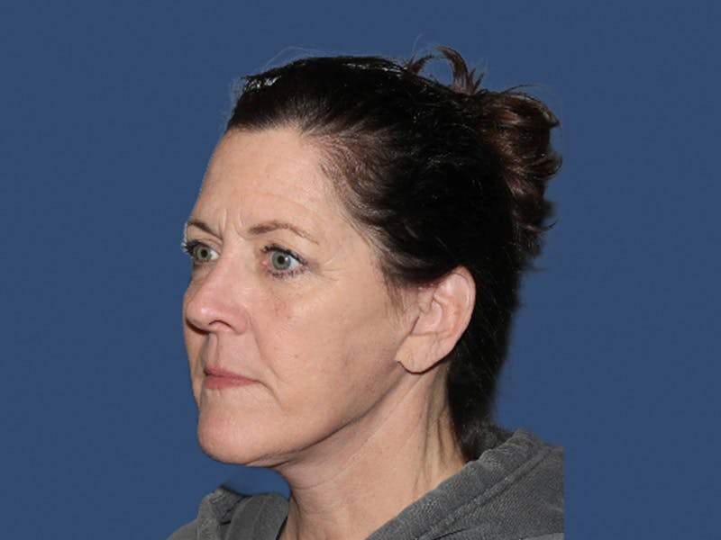 Facelift Before & After Gallery - Patient 309242 - Image 4