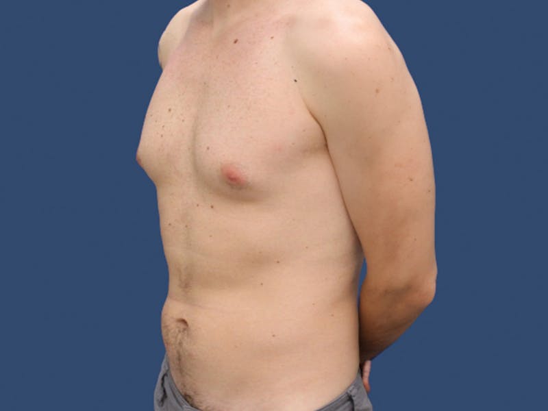 Gynecomastia Before & After Gallery - Patient 134198 - Image 1