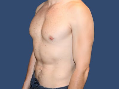 Gynecomastia Before & After Gallery - Patient 134198 - Image 2
