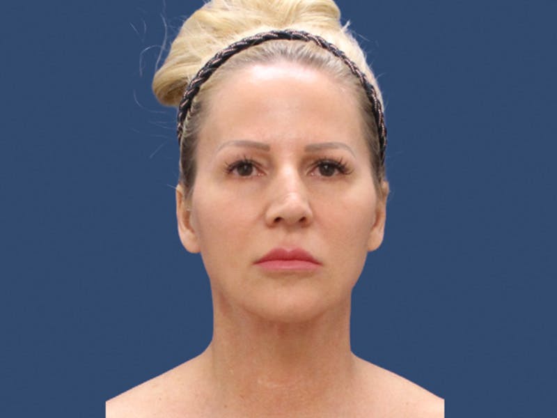 Neck Lift Before & After Gallery - Patient 303520 - Image 2