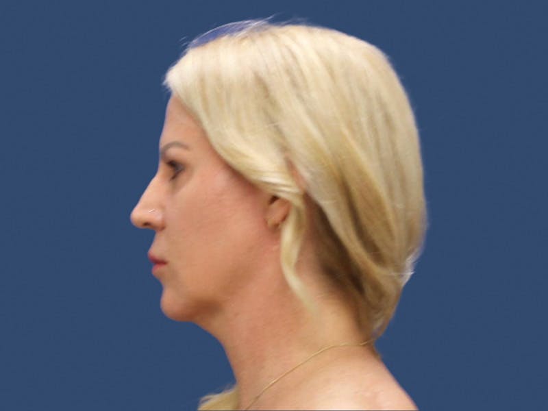 Neck Lift Before & After Gallery - Patient 303520 - Image 3