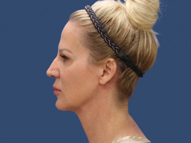Neck Lift Before & After Gallery - Patient 303520 - Image 4