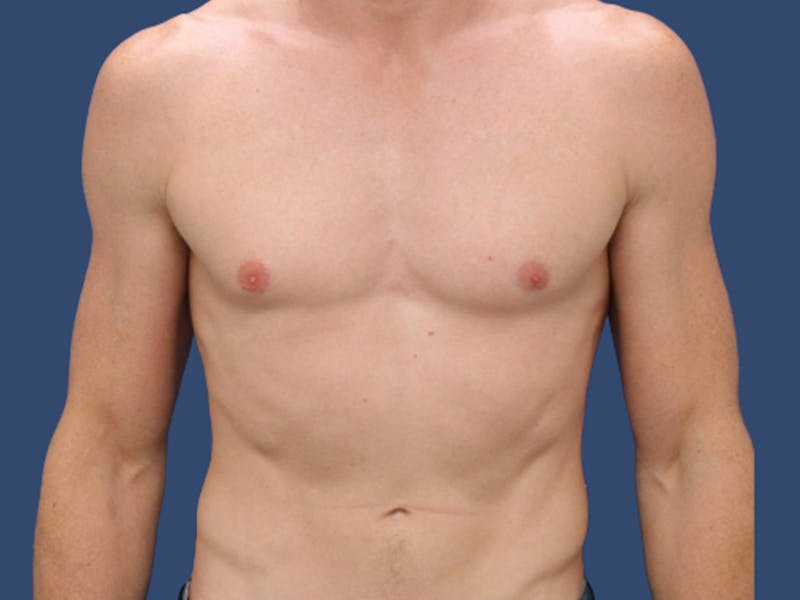 Gynecomastia Before & After Gallery - Patient 821095 - Image 1