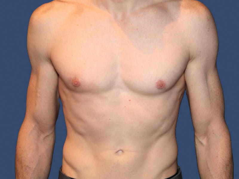 Gynecomastia Before & After Gallery - Patient 821095 - Image 2