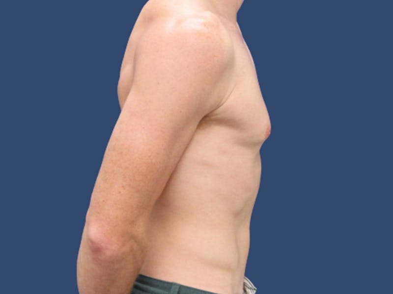 Gynecomastia Before & After Gallery - Patient 821095 - Image 3