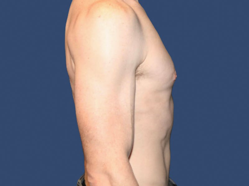 Gynecomastia Before & After Gallery - Patient 821095 - Image 4