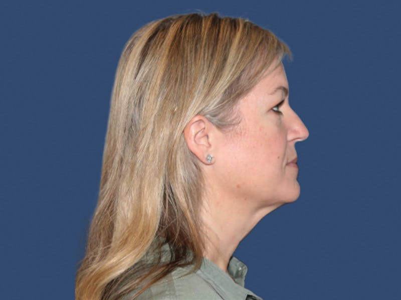 Neck Lift Before & After Gallery - Patient 235471 - Image 3