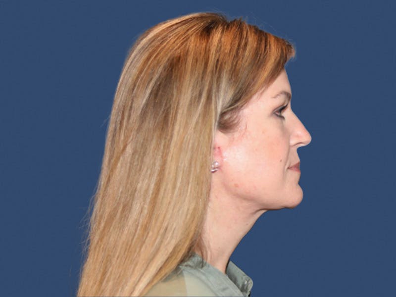 Facelift Before & After Gallery - Patient 265166 - Image 4