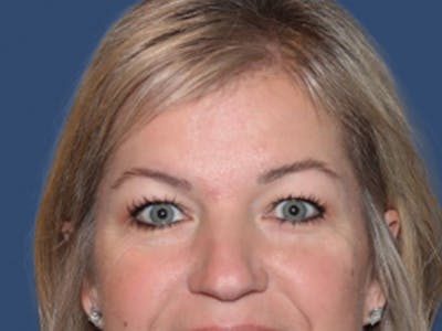 Eyelid Surgery Before & After Gallery - Patient 129738 - Image 1