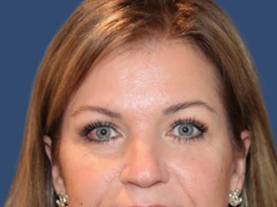 Eyelid Surgery Before & After Gallery - Patient 129738 - Image 2