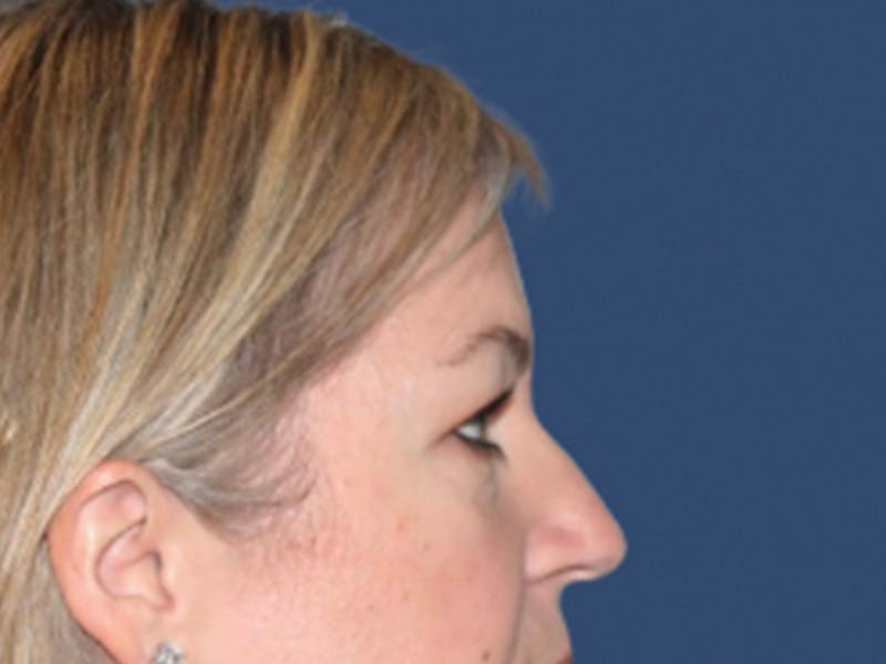 Eyelid Surgery Before & After Gallery - Patient 129738 - Image 3