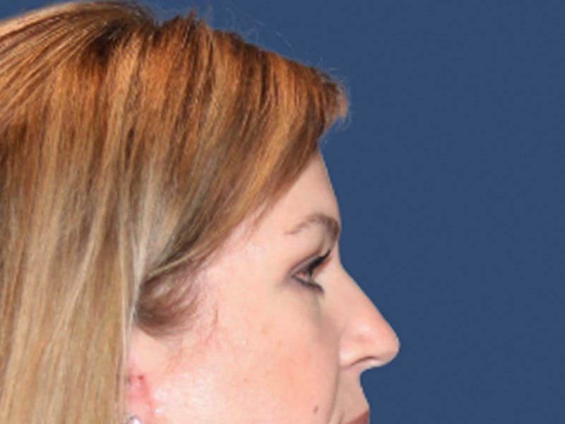 Eyelid Surgery Before & After Gallery - Patient 129738 - Image 4
