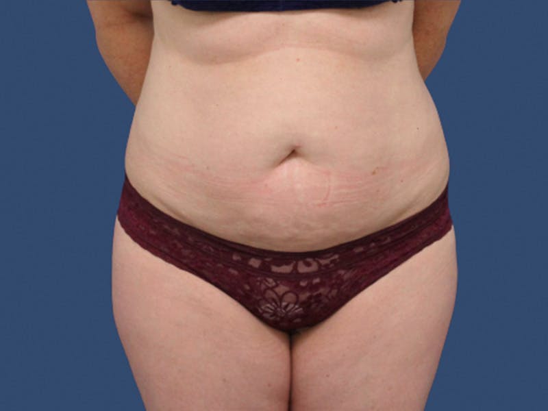 Tummy Tuck Before & After Gallery - Patient 245689 - Image 1