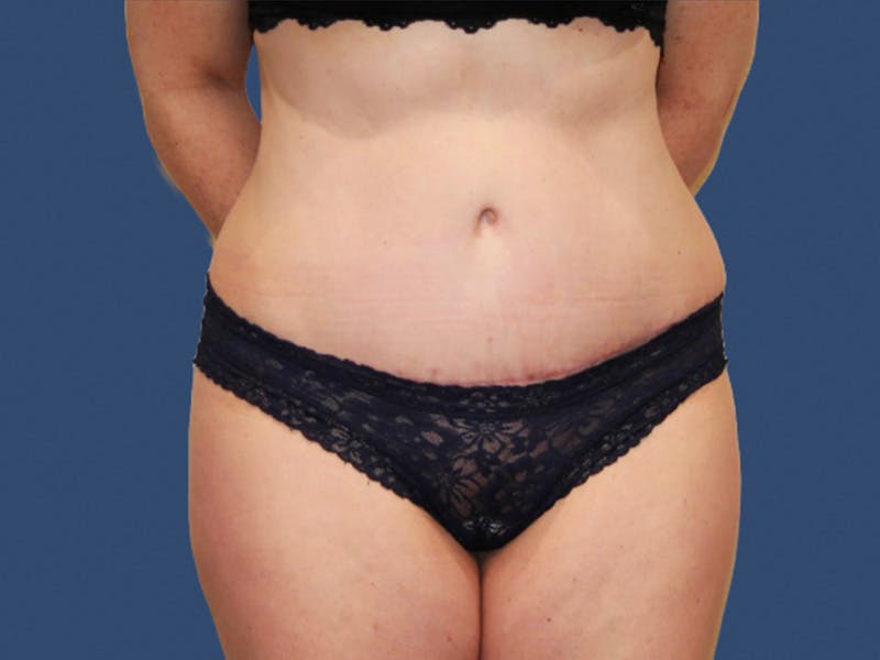 Tummy Tuck Before & After Gallery - Patient 245689 - Image 2