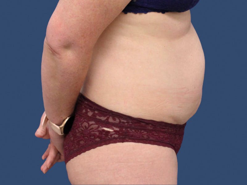 Tummy Tuck Before & After Gallery - Patient 245689 - Image 3