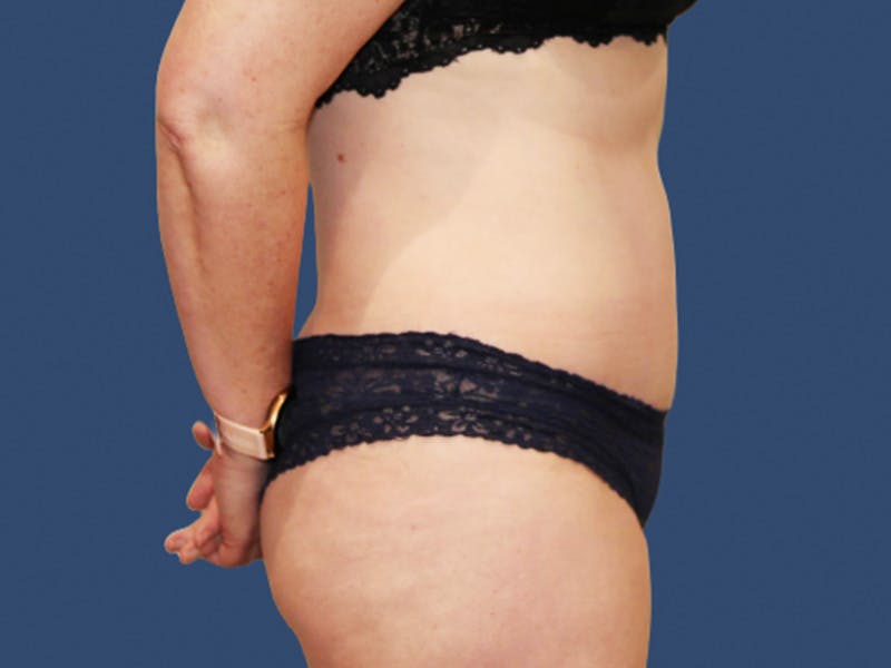 Tummy Tuck Before & After Gallery - Patient 245689 - Image 4