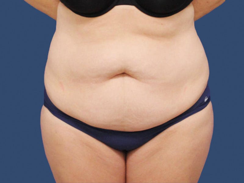 Tummy Tuck Before & After Gallery - Patient 723894 - Image 1
