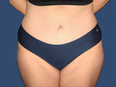 Tummy Tuck Before & After Gallery - Patient 723894 - Image 2