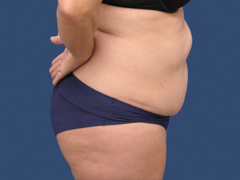 Tummy Tuck Before & After Gallery - Patient 723894 - Image 3