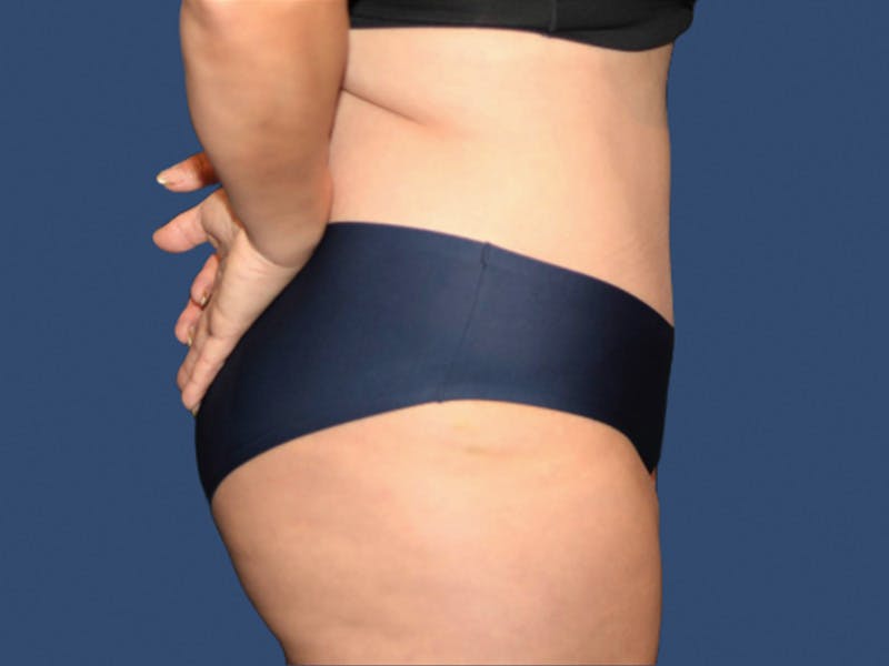 Tummy Tuck Before & After Gallery - Patient 723894 - Image 4