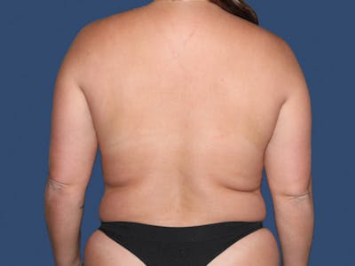 Liposuction Before & After Gallery - Patient 322300 - Image 1