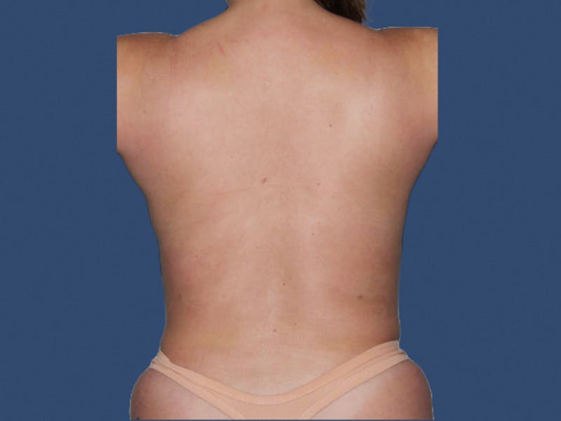 Liposuction Before & After Gallery - Patient 322300 - Image 2