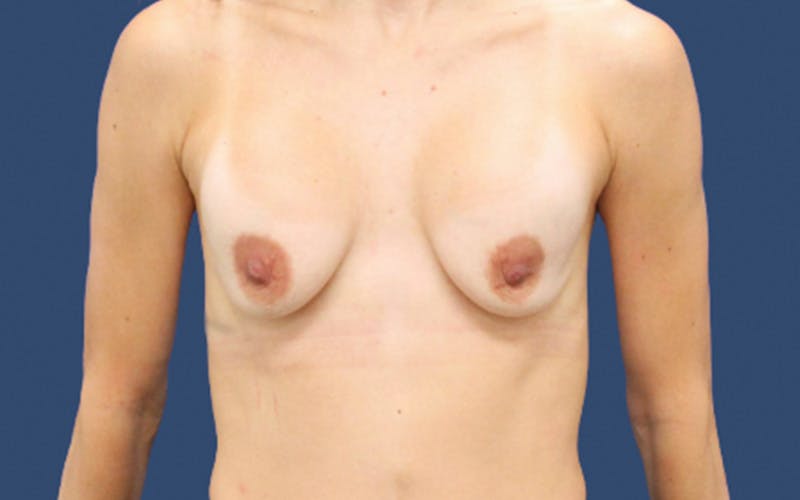 Breast Revision Before & After Gallery - Patient 230737 - Image 1