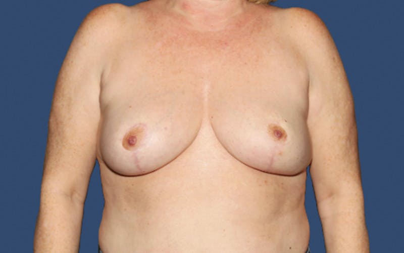 Breast Lift Before & After Gallery - Patient 386046 - Image 2