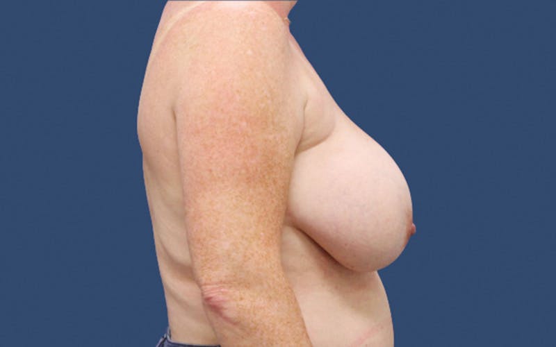 Breast Lift Before & After Gallery - Patient 386046 - Image 3