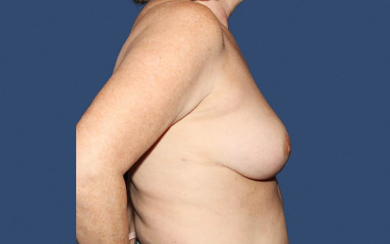 Breast Revision Before & After Gallery - Patient 270500 - Image 4