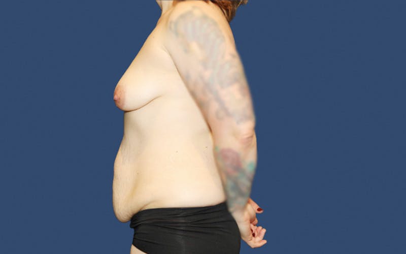 Tummy Tuck Before & After Gallery - Patient 453793 - Image 3