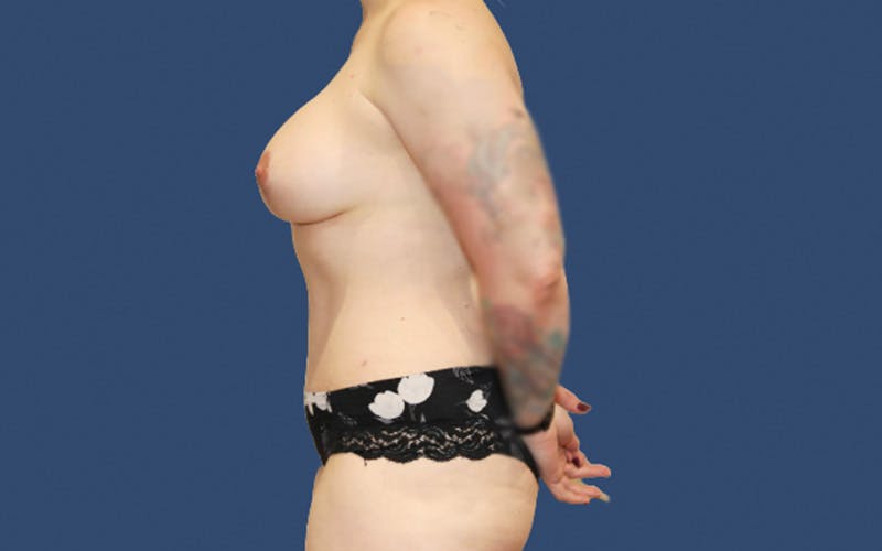 Tummy Tuck Before & After Gallery - Patient 453793 - Image 4