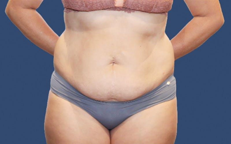Tummy Tuck Before & After Gallery - Patient 858188 - Image 1