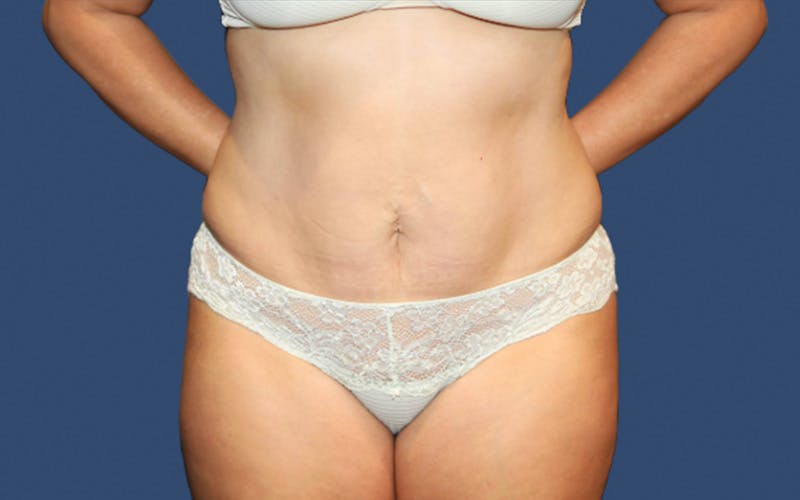Tummy Tuck Before & After Gallery - Patient 858188 - Image 2