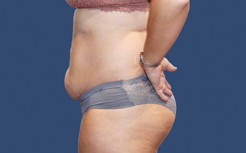Tummy Tuck Before & After Gallery - Patient 858188 - Image 3