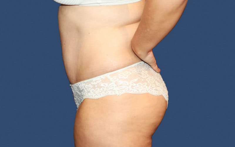 Tummy Tuck Before & After Gallery - Patient 858188 - Image 4