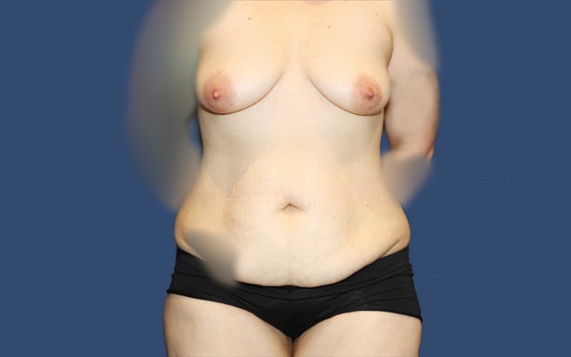Mommy Makeover Before & After Gallery - Patient 165469 - Image 1