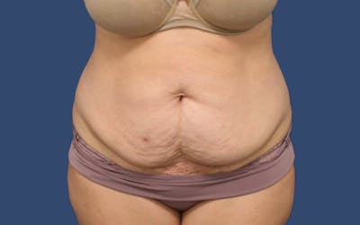 Tummy Tuck Before & After Gallery - Patient 283619 - Image 1