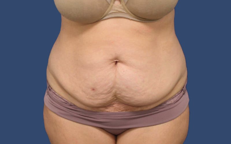 Tummy Tuck Before & After Gallery - Patient 283619 - Image 1