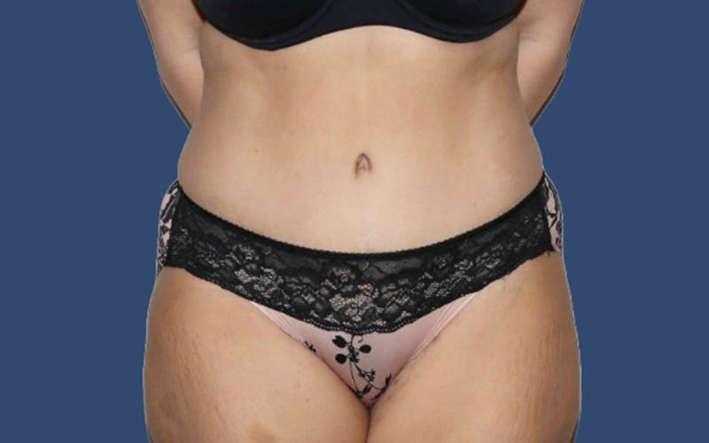 Tummy Tuck Before & After Gallery - Patient 283619 - Image 2