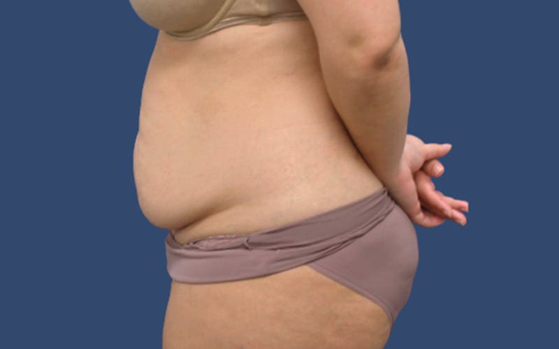 Tummy Tuck Before & After Gallery - Patient 283619 - Image 3