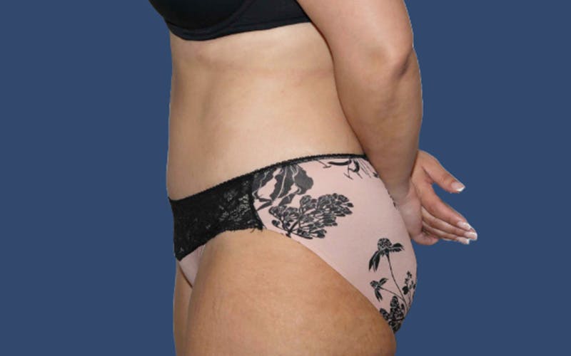 Tummy Tuck Before & After Gallery - Patient 283619 - Image 4