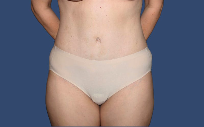 Mommy Makeover Before & After Gallery - Patient 296010 - Image 2